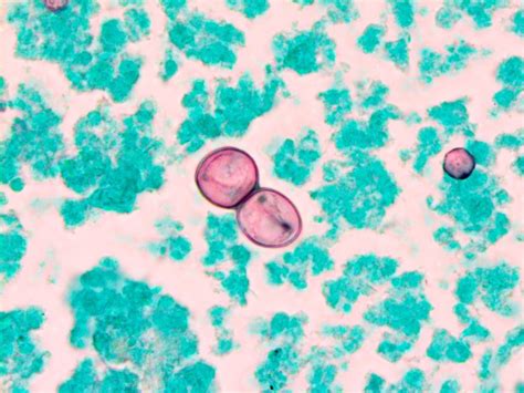 Microbiology Case Study: An Unusual Morphologic Presentation of an Uncommon Dimorphic Fungi in ...