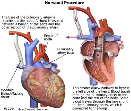 Norwood Operation