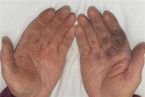 Derm Dx: Black discoloration of the hands - Clinical Advisor