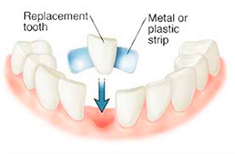 Dental Bridge - Procedure, Dental Bridge Vs Dental Implant