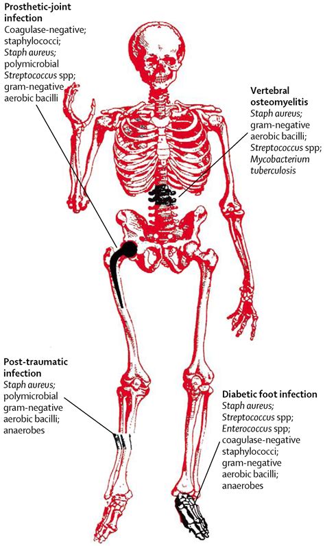 Osteomyelitis - The Lancet