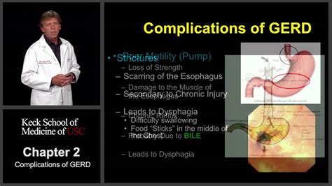 Chapter 2: Complications of GERD - YouTube