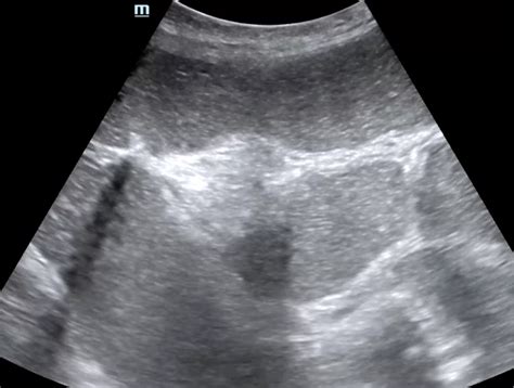 Intern Ultrasound of the Month: Small (& Large) Bowel Obstruction — University Hospitals ...