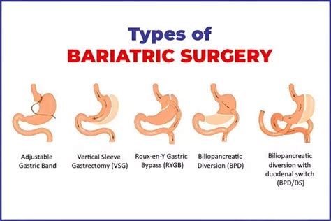 Types of Bariatric Surgery