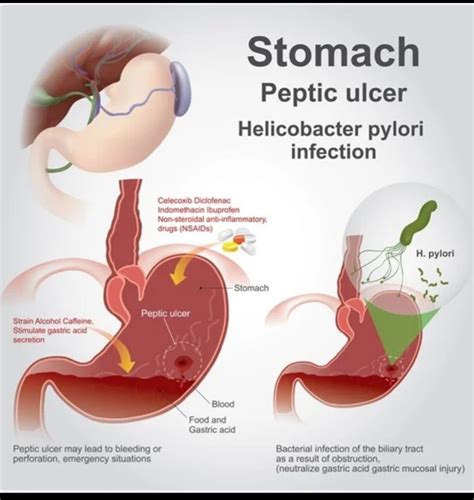 Peptic ulcer - MEDizzy