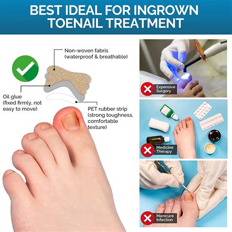 Glue-Free Ingrown Toenail Corrector Patch - 50 Pcs | Treatment Tool for Ingrown Toenails