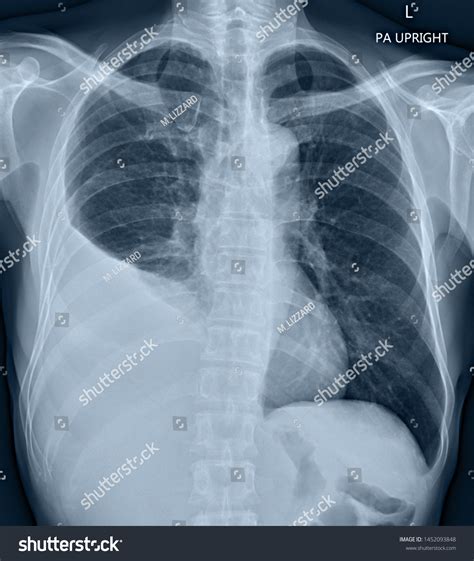 9 рез. по запросу «Loculated pleural effusion» — изображения, стоковые фотографии и векторная ...