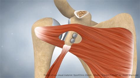 Animation Latarjet procedure - MedicalGraphics