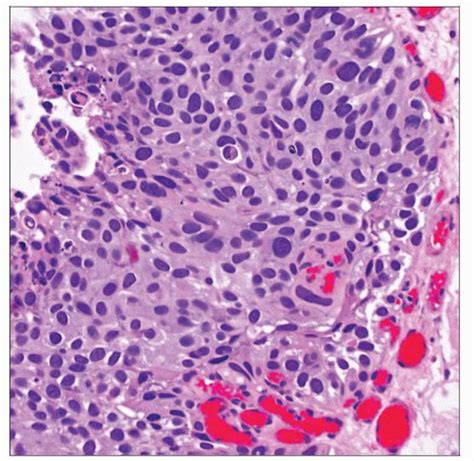 High-Grade Papillary Urothelial Carcinoma | Basicmedical Key