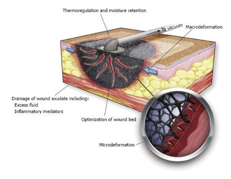 Wound VAC Process, Benefits, Side Effects, Complications,, 47% OFF