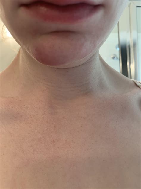 [Skin Concern] The right side of my chin is what it normally looks like ...