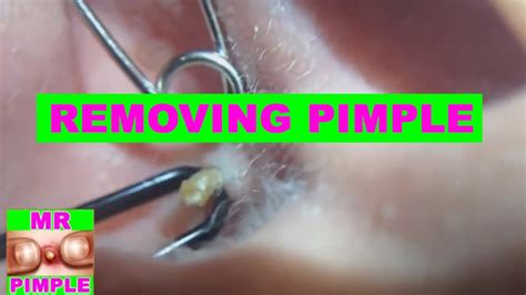 Removing Pimple Inside The Ear - Mr. Pimple - YouTube