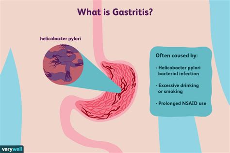 Gastritis: Overview and More