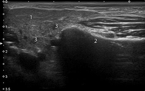 Parotid Gland Ultrasound Measurement