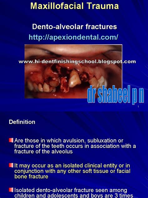 Dento Alveolar Fractures | PDF | Tooth | Face