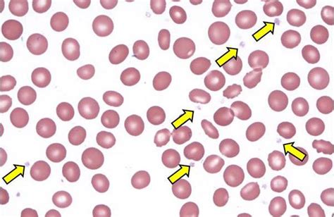 Platelets – what are they ? | Medical Laboratories