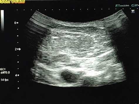 VIETNAMESE MEDIC ULTRASOUND: CASE 542: NECK TUMOR LIPOMA, Dr PHAN THANH HAI, MEDIC MEDICAL ...