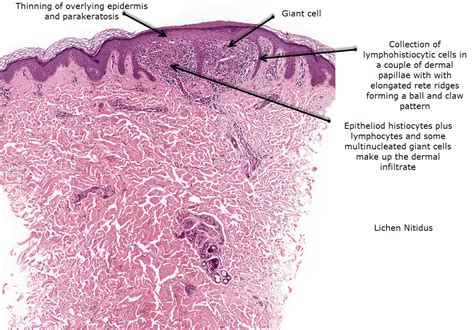 Dermatopathology Made Simple - Inflammatory: Lichenoid / Vacuolar ...