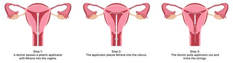 Mirena Insertion | What to Expect with Mirena IUD Placement