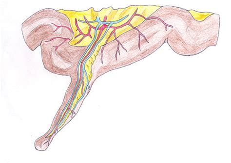 Meckel's diverticulum pathophysiology - wikidoc