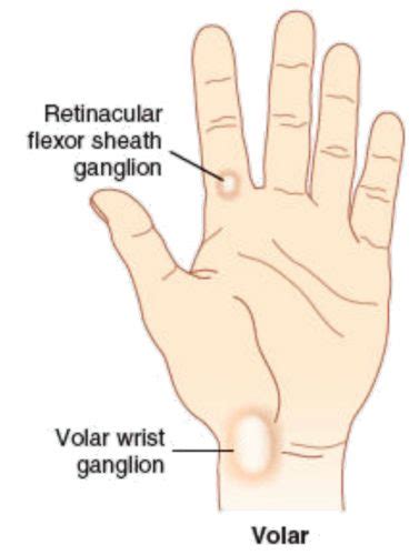 Synovial Cyst Finger Joint