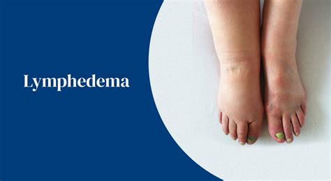 What is LYMPHEDEMA? - Georgia Infectious Diseases Specialist | Wound Care Center