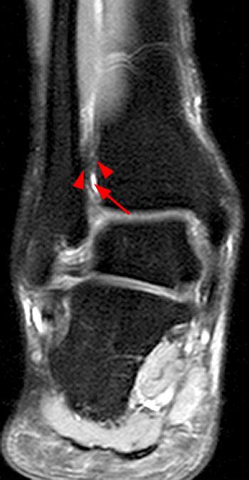 High Ankle Sprains | Radsource