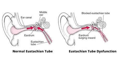 Ear Barotrauma | Pressure In Ears Symptoms & Best Treatment (2022)