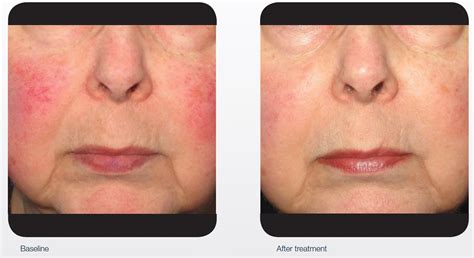 IPL/laser for redness & broken capillaries – QSD