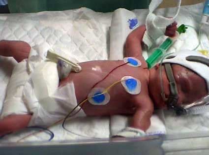 Short-term & Long-term Complications a Premature Baby May Face - Preemie Twins Baby Blog