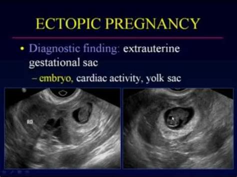 Ectopic Pregnancy Ultrasound Vs Normal Pregnancy