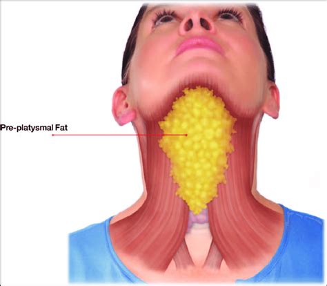 How to dissolve double chin fat without surgery - VCI