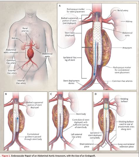 Abdominal Aortic Aneurysm Near Renal Artery Endovascular Repair | My XXX Hot Girl
