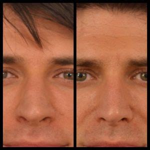 Male Rhinoplasty in Los Angeles - Rhinoplasty Los Angeles | Best Nose Surgery Options | Dr ...