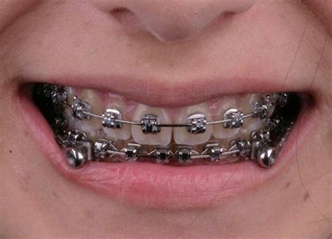 #braces #girlswithbraces #herbst #herbstappliance | Teeth braces ...