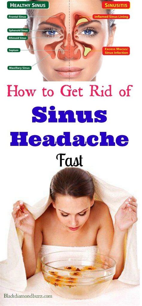 7 Home Remedies for Sinus Headache Fast Relief.... Sinusitis occurs when the four nasal cavit ...