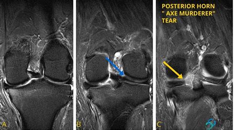 Meniscus Posterior Horn Part 1: An axe murderer meets the ghost meniscus - Radedasia