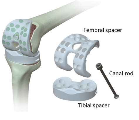 Polymers | Free Full-Text | Polyethylene-Based Knee Spacer for Infection Control: Design Concept ...