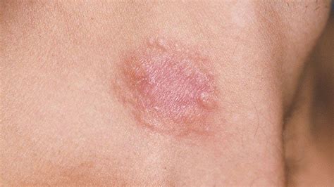 Skin Cancer Rash On Back