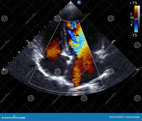 Doppler echocardiography stock photo. Image of atrium - 52734328