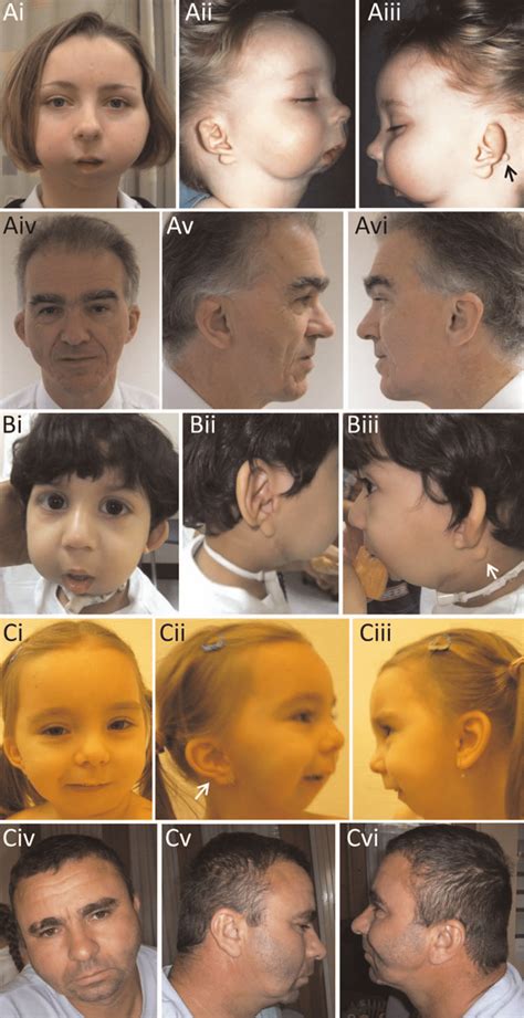 Craniofacial features of auriculocondylar syndrome patients harbouring... | Download Scientific ...