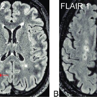 Examples of new punctate lesions (arrows) on longitudinal FLAIR images... | Download Scientific ...