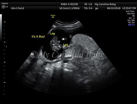 Gender Reveal Ultrasound in Charlotte, NC | My Carolina Baby