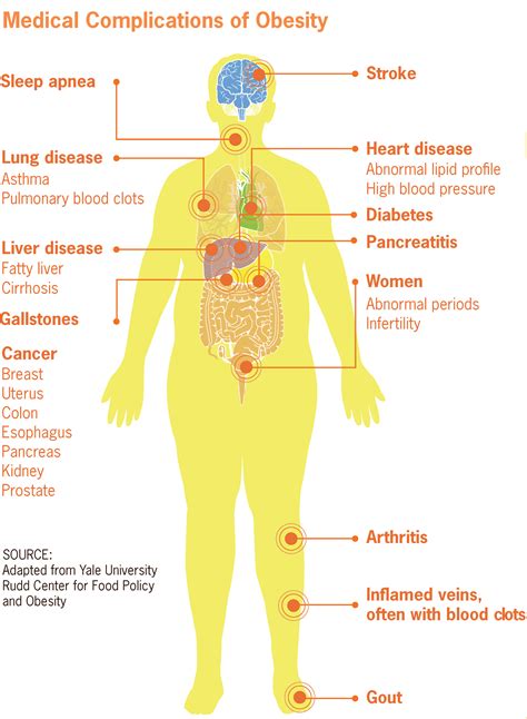 Obesity-associated morbidity - Wikipedia