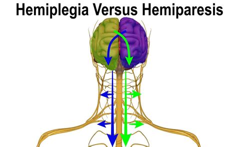 Hemiplegia Versus Hemiparesis - Rehab HQ