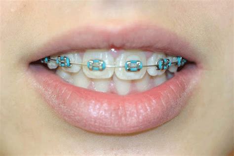 baby blue chain braces - Great Band Blogger Photo Galery