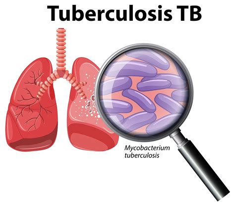 Human Lung with Tuberculosis 363213 Vector Art at Vecteezy