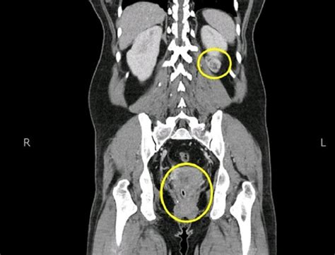 Computed tomography (CT) scan of the abdomen and pelvis showing a ...