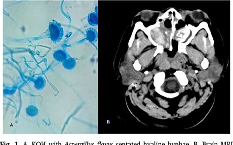 Figure 1 from Invasive fungal infection by Aspergillus flavus in ...