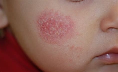 Dry Patches on Face : Health Blog